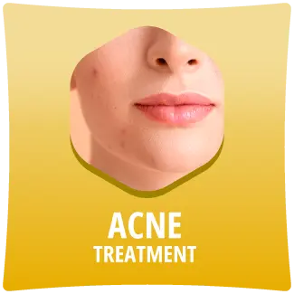 Acne Treatment
